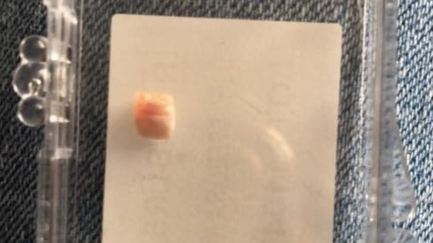 Baby girl, 12 days old, has tooth removed